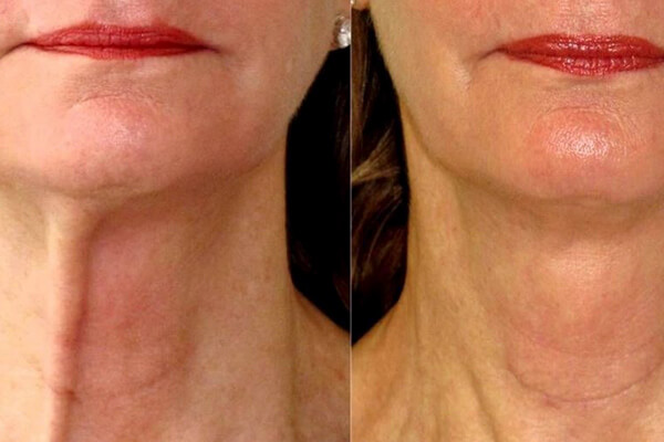 Caren Az Beauty Injector
